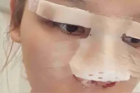 女子花了3万隆鼻，谁知竟变成了“朝天鼻”？劝告：整容有风险图片