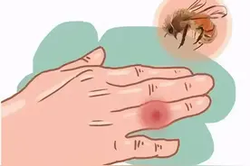 蜂蛰伤严重可致死！正确处理方法是这样……图片