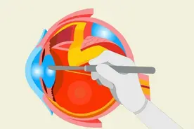 想做白内障手术，却不知如何选择人工晶体？听听医生怎么说图片