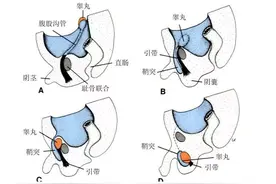 “孩子下面鼓了个包”，家有男宝宝，出现这个症状别大意图片
