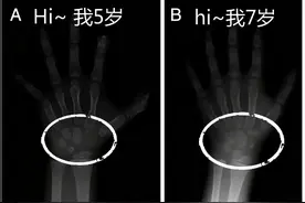 儿科医生整理：关于骨龄的那些事，看这一篇就够了，真的很全图片