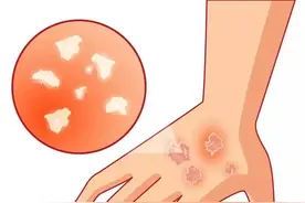 阴囊脱皮痒干燥起鳞片白花花皮屑图片