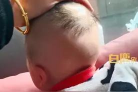 宝宝满月剃胎毛后局部难长发，妈妈：诊断毛囊闭合，实在不行只能植发了图片