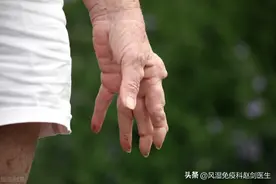 类风湿结节出现是否意味着病情“恶化”？风湿医生揭晓答案图片