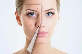 内分泌失调引起的痘痘怎么办？教你几招应对方法图片