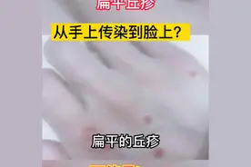 手上冒出疙瘩，还越长越多？还长到脸上？那可能是传染了图片