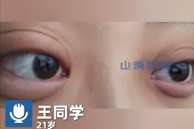 女生和男友吵架分手，哭3小时眼睛肿成“悲伤蛙”：次日才消肿，拍照发给朋友然后继续吐槽前男友图片