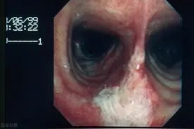 戒烟后，却查出肺癌！肺癌到底是吸烟引起的，还是戒烟引起的？图片