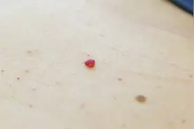 身上长红痣是肝病信号？注意：肝开始病变时，手脚可能有3种迹象图片