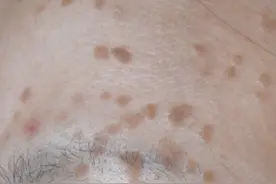 扁平疣是怎么引起的，如何治疗？图片