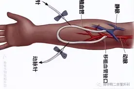 血液透析的生命线——人工血管动静脉内瘘图片