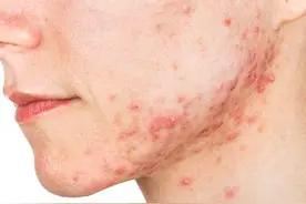 爱生痤疮痘痘，可能是这些原因引起的。图片