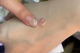 女大学生美甲变“灰指甲”索赔双倍医药费，商家自认无错建议起诉图片