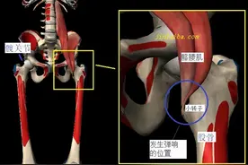 大腿内侧隐隐作痛？可能是“弹响髋”惹的祸图片