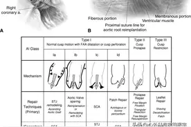 主动脉瓣修复术图片