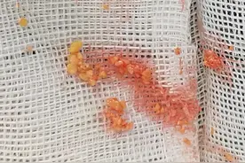 丁小邦治疗故事：手术室实拍，太阳穴奥美定取出物似“花生碎”图片