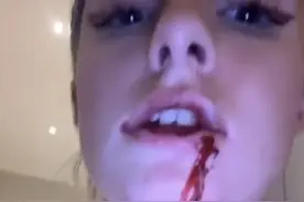 00后模特女友被曼联红星殴打！晒嘴角流血照控诉，身上多处淤青图片