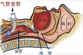 气管切开一般多久可以闭管，怎么护理？图片