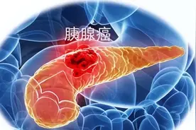 什么是胰腺癌？胰腺癌和饮食有关系吗？一文讲清图片
