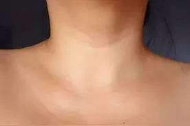 发现颈动脉斑块怎么办图片