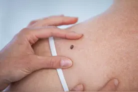 再三提醒：黑痣长在这6个部位，或与癌症“密切相关”，及时处理图片