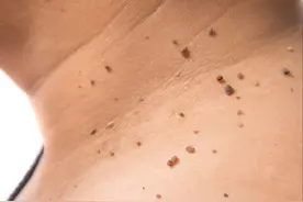 脖子上起的“小肉疙瘩”不痛不痒？或潜在3个病在“捉弄”你图片