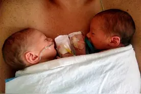 双胞胎兄弟相继患癌，哥哥强忍病痛一年捐骨髓给弟弟，结局太感动图片