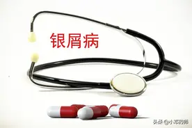 治疗银屑病的他卡西醇能长期使用吗？需要注意什么？图片