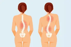 粗心家长太大意，15岁少女脊柱侧弯错过最佳治疗时机！图片