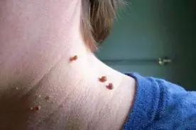 脖子上长小肉球，这是怎么回事？或与这6种情况有关图片