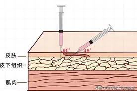 针头是空心的，那打针时戳到的肉去哪儿了？图片