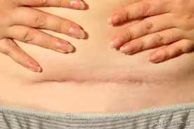 剖宫产后——瘢痕的护理！图片