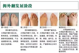 什么是拇趾外翻？图片