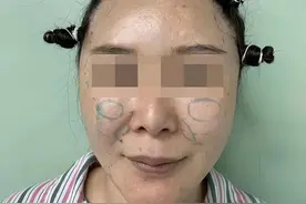 填充上百支玻尿酸，皮肉分离变“泡泡脸”？34岁女士公开修复之路图片