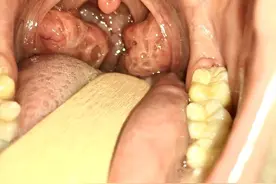 睡觉打呼、扁桃体反复发炎、扁桃体肥大，不想手术怎么办？图片