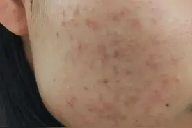 刷酸到底怎么刷？听医生忠告避免烂脸图片