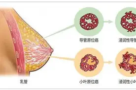 乳房全切，生存超过8年的肿瘤又复发！最后她找了中医调理图片