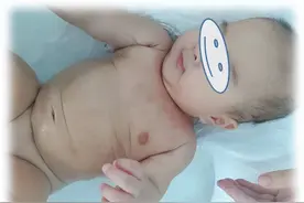 【绿色治疗】痒！皮肤问题！省儿童医院臭氧水疗来帮忙图片