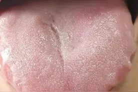 裂纹舌有齿痕，多是胃病缠身，痰湿重，送你2个中成药，健脾祛湿图片