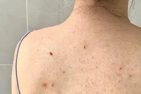 后背长痘不必惊慌！学会这三招！在家轻松摆脱顽固粉刺、脓包！图片