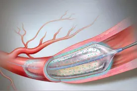 支架手术后戒烟戒酒，不到2年再次心梗？医生说出和这2个原因有关图片