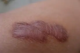 90天祛疤膏大测评，看似平平无奇小国货，淡化疤痕增生轻轻松松！图片