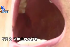 种牙五六年 连累到邻牙？图片