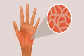 一到晚上就瘙痒难忍的荨麻疹，怎么回事？中西医结合帮你摆脱它图片