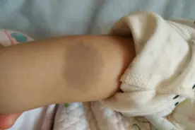 胎记是怎么来的？不想宝宝长胎记，准妈妈要尽量避开4种行为图片