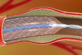 装上心脏支架后，还能活多少年呢？医生揭露真相，看完涨知识了图片