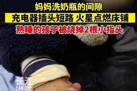 痛心！充电器短路造成一岁半男童两根手指头被烧掉图片