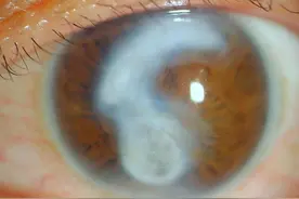 黑眼球变白眼球，该做什么样眼科手术？—如何治疗角膜白斑白内障图片