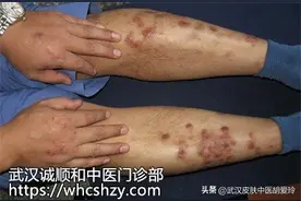 小腿皮肤粗糙发出一个一个的褐色小疙瘩剧痒吃什么药能止痒图片