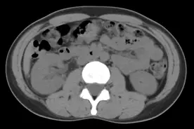 40岁发现急性肾盂肾炎，抗感染治疗后终恢复图片